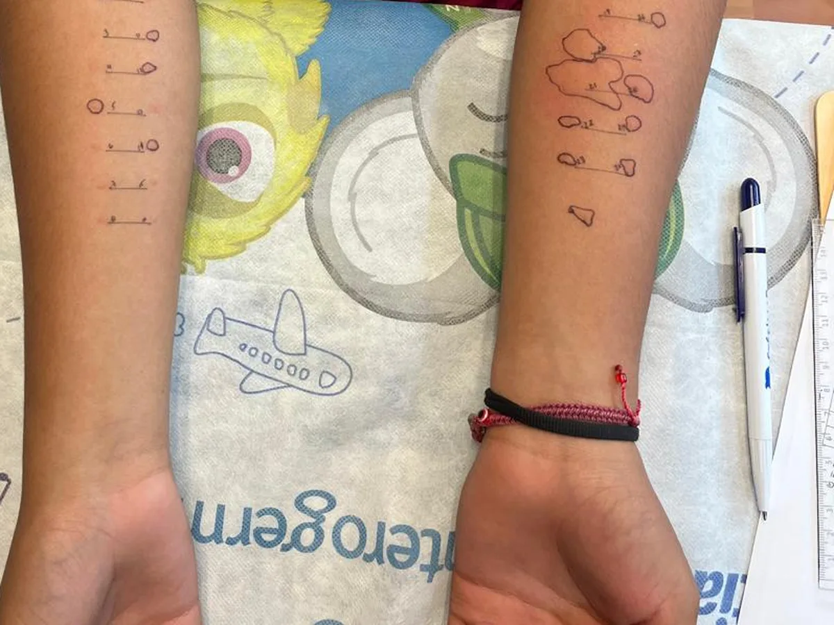 Prueba cutánea de alergias en los antebrazos de un paciente