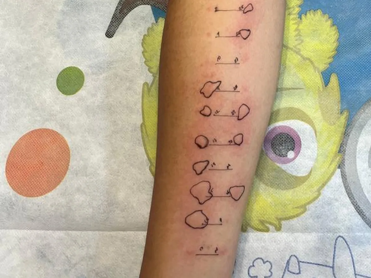 Prueba cutánea de alergias en el antebrazo de un paciente