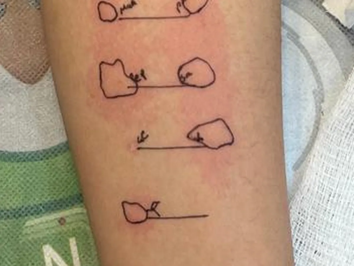 Prueba cutánea de alergias en el antebrazo de un paciente
