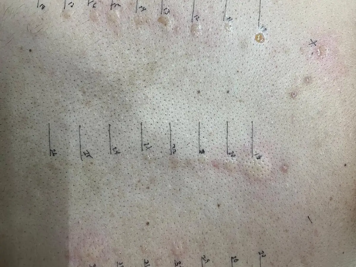 Prueba cutánea de alergias en la espalda de un paciente