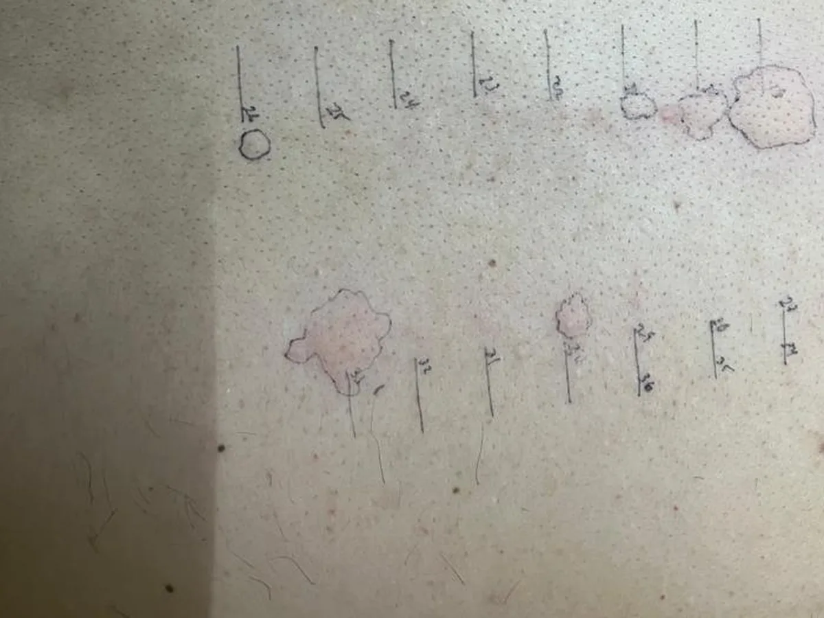 Prueba cutánea de alergias en la espalda de un paciente