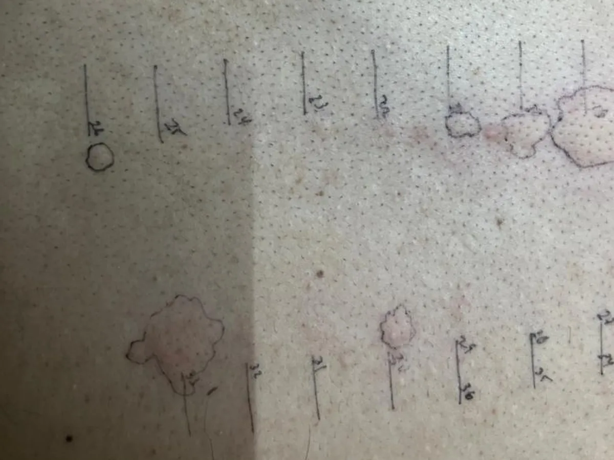 Prueba cutánea de alergias en la espalda de un paciente